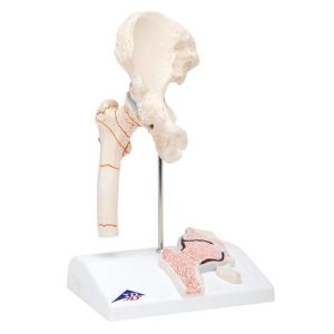 Dijbeenbreuk en hiposteoarthritis