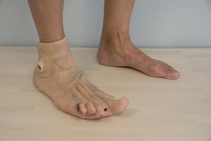 Draagbaar Diabetisch Voetmodel