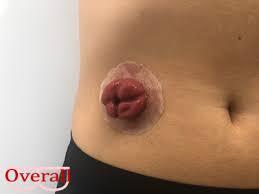 Draagbare Stoma Opzetstukken Set (5 stuks)