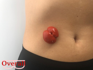 Draagbare Stoma Opzetstukken Set (5 stuks)