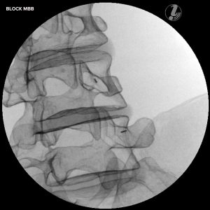 Beeldgeleide Lumbale Wervelkolom Injectie Simulator