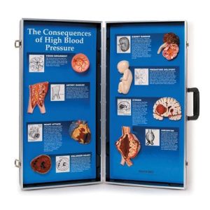 Gevolgen Hoge Bloeddruk 3D Display
