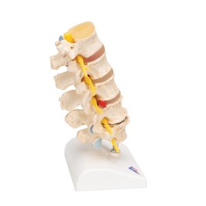 Lumbale Hernia stadia en degeneratie