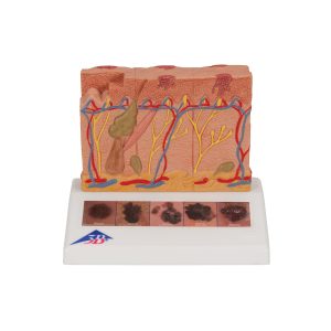 Huidkanker model