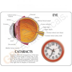 Oogmodel met staar (Cataract)