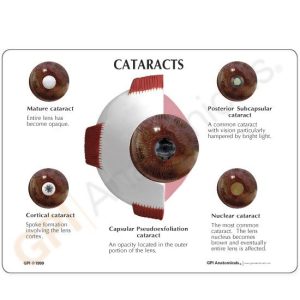 Oogmodel met staar (Cataract)