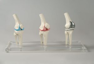 Knie-implantaat model
