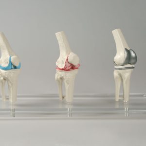 Knie-implantaat model