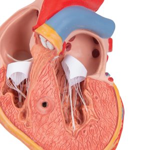 Klassiek hart met linker ventrikel hypertrofie(LHV) 2-delig