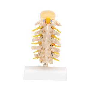 Lumbale Hernia stadia en degeneratie