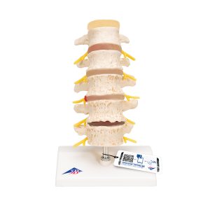 Lumbale Hernia stadia en degeneratie