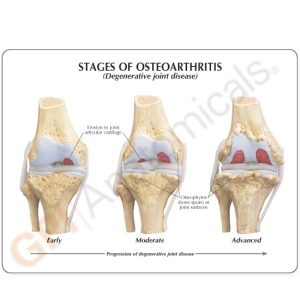 Knie, 4 stadia osteoarthritis