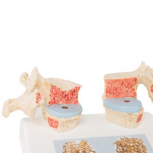 Osteoporose model