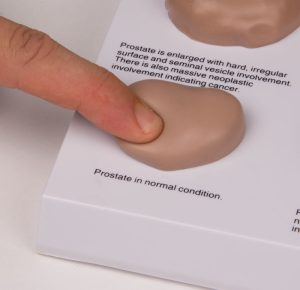 Prostaat Model met Ziektes