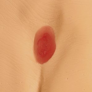 Decubitus Modellen Set (4 stuks)