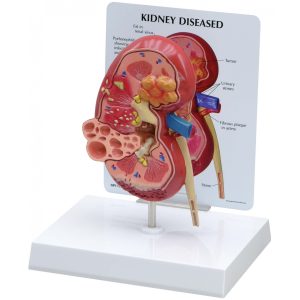 Niermodel met ziektebeelden + infokaart