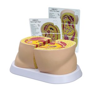 Obesitas model