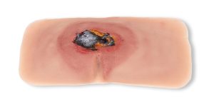 Decubitus Wond Model, Onbehandeld