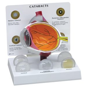 Oogmodel met staar (Cataract)