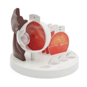 Oog met ziektebeelden