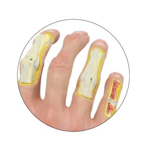 Anatomisch Model Osteoartritis Hand