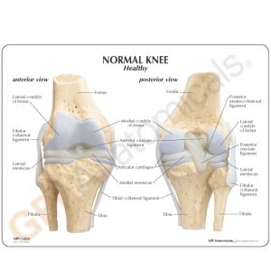 Knie, 4 stadia osteoarthritis