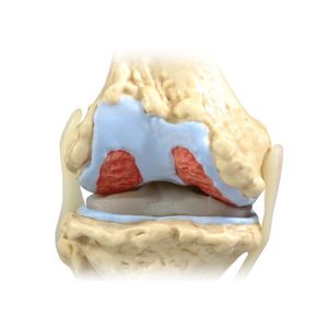 Knie, 4 stadia osteoarthritis