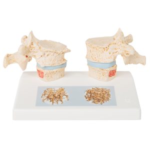 Osteoporose model