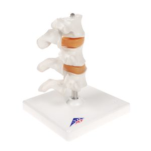 Deluxe Osteoporose model