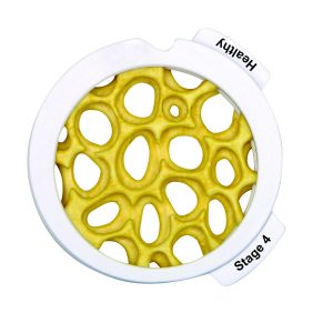 Osteoporose Schijven Set (4 stadia)