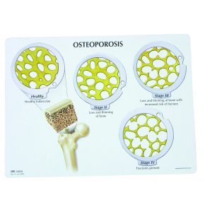 Osteoporose Schijven Set (4 stadia)