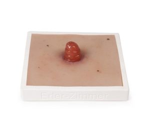 Ileostoma Model