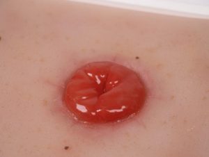 Colostoma Model