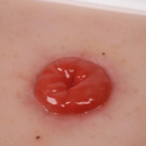 Colostoma Model