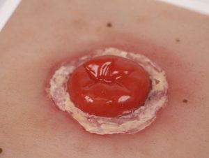 Colostoma met Ontsteking Model