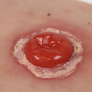 Colostoma met Ontsteking Model