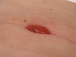 Colostoma in Buikplooi Model