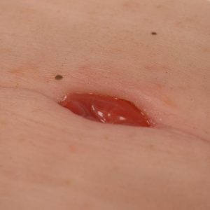 Colostoma in Buikplooi Model