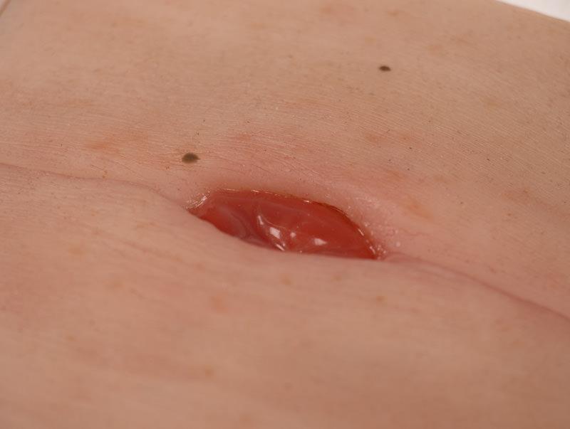 Colostoma in Buikplooi Model