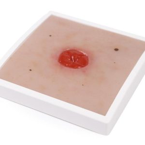 Colostoma onder huidniveau Model