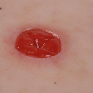 Colostoma onder huidniveau Model