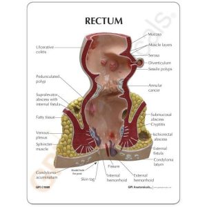 Endeldarm (Rectum), model met infokaart