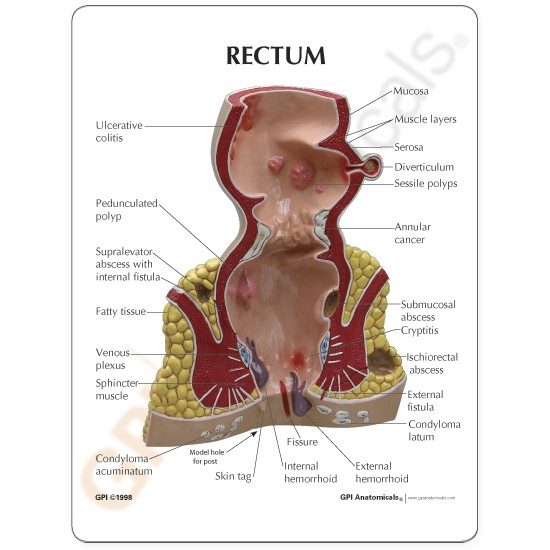 Endeldarm (Rectum), model met infokaart