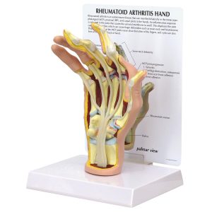 Reumatische Artritis Hand Model