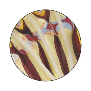 Reumatische Artritis Hand Model
