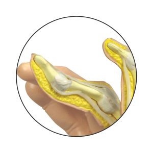 Reumatische Artritis Hand Model