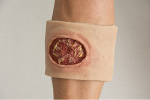 Rood-gele wond met draagband