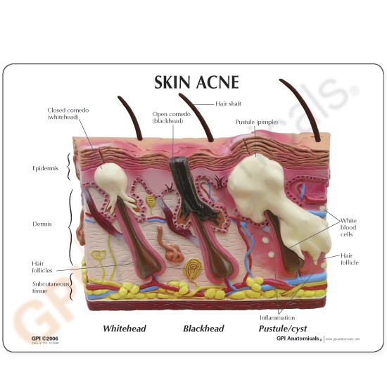 Huidacne Model, Dubbelzijdig