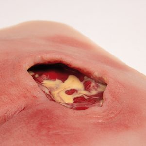 Decubitus Wond Model, Gereinigd