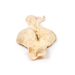Abdominaal Aorta Aneurysma, 3D Print